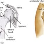 HIP_REPLACEMENT_SURGERY_COST_IN_INDIA