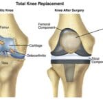 KNEE_REPLACEMENT_SURGERY_IN_INDIA