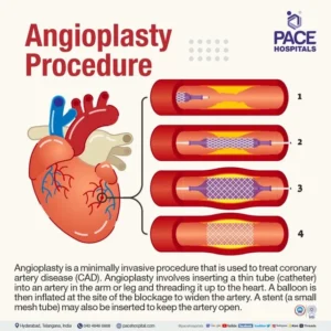 best+hospital+for+angioplasty+in+hyderabad-+india-640w